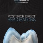 Posterior Direct Restorations