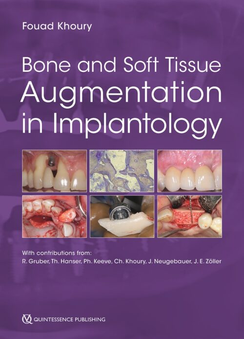 Bone and Soft Tissue Augmentation in Implantology