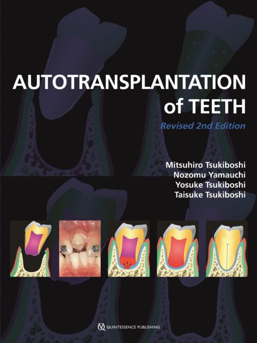 Autotransplantation of Teeth