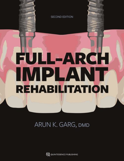 Full-arch Implant Rehabilitation