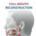 Full-Mouth Reconstruction 1st Edition 2026