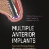 Multiple Anterior Implants