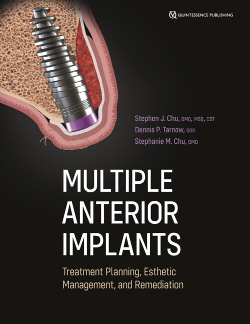 Multiple Anterior Implants
